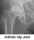 Arthritic Hip