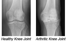 Healthy Knee Joint and Arthritic Knee Joint