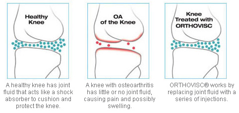 ORTHOVISC